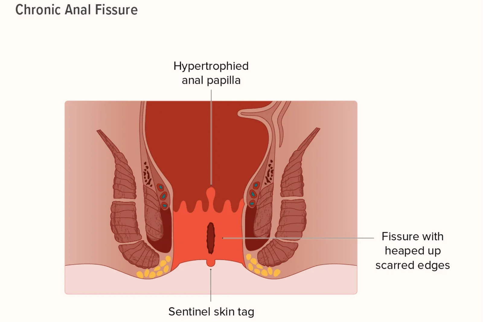 anal fissure surgery in indore, anal treatment in indore- Indore Laparoscopy Center