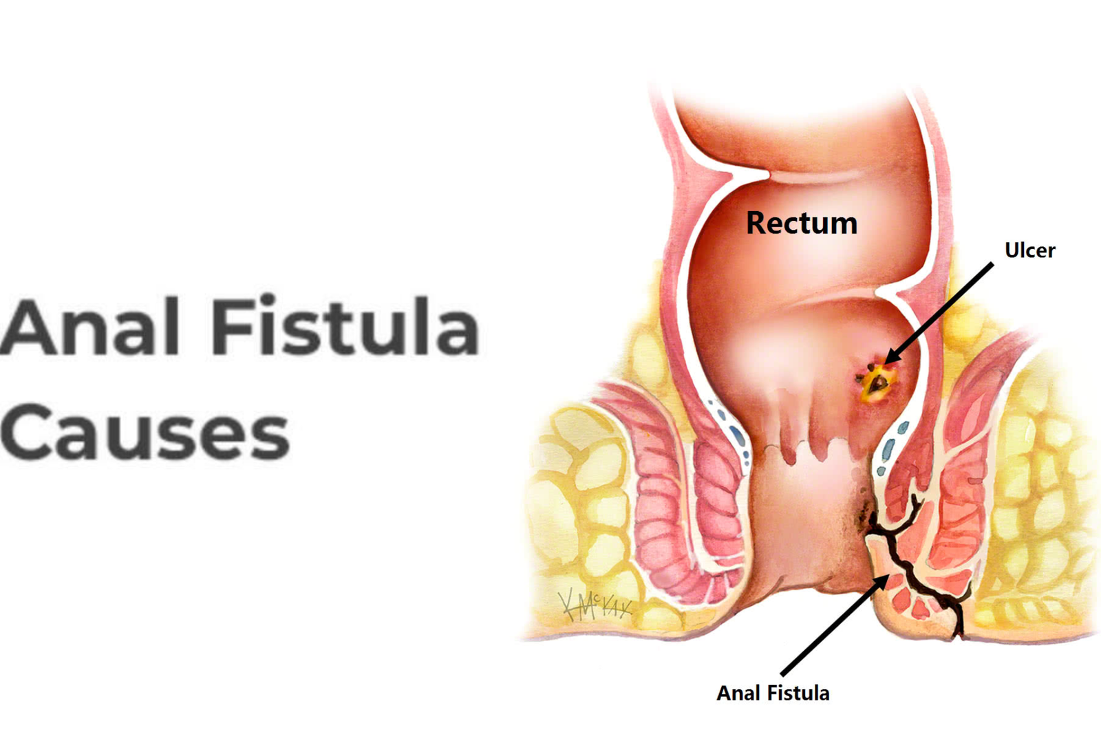 fistula surgery in indore, best fistula treatment in indore- Indore Laparoscopy Center