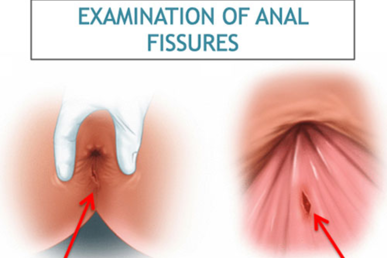 best fissure surgery in indore, fistula treatment in indore- Indore Laparoscopy Center