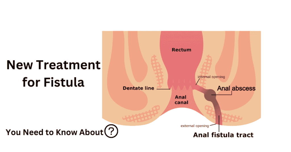 new treatment for fistula