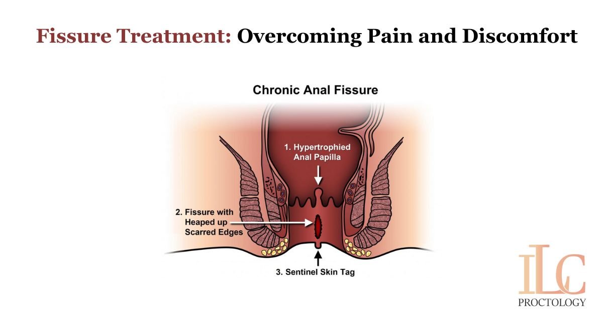Fissure Treatment: Overcoming Pain and Discomfort