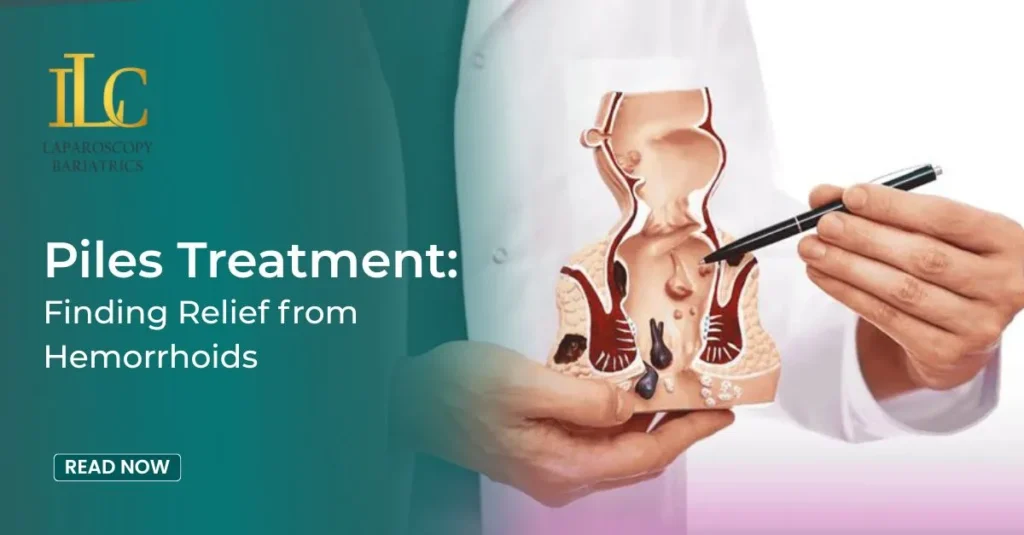 Piles Treatment Finding Relief from Hemorrhoids