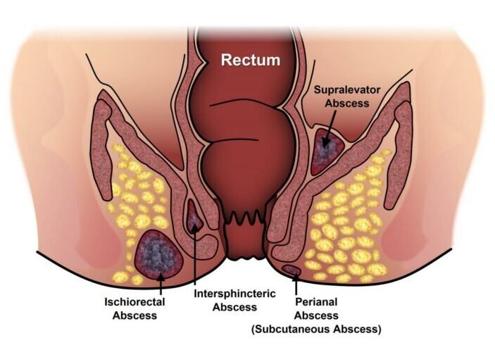 Top Fissure Doctor in India | Dr. Achal Agrawal