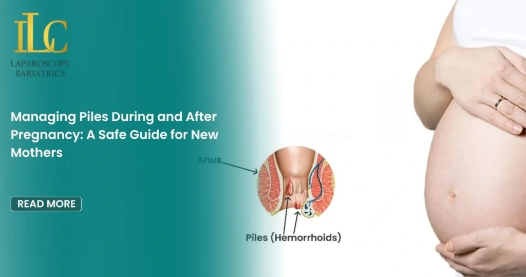 Managing Piles During and After Pregnancy A Safe Guide for New Mothers