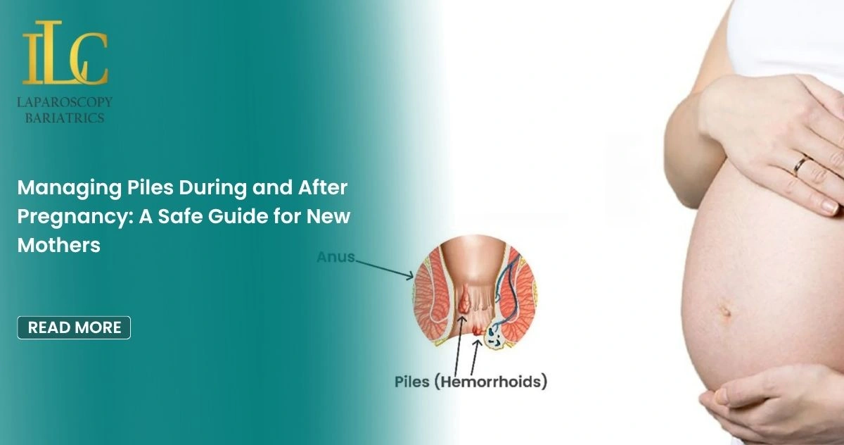 Managing Piles During and After Pregnancy A Safe Guide for New Mothers