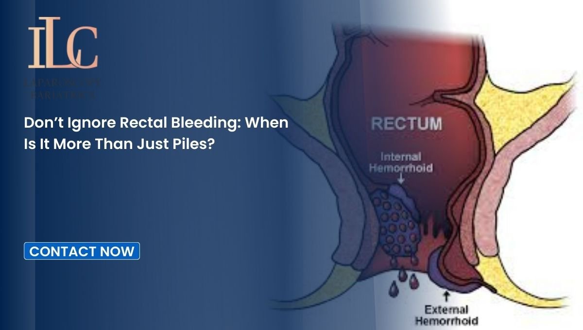 Don’t Ignore Rectal Bleeding When Is It More Than Just Piles
