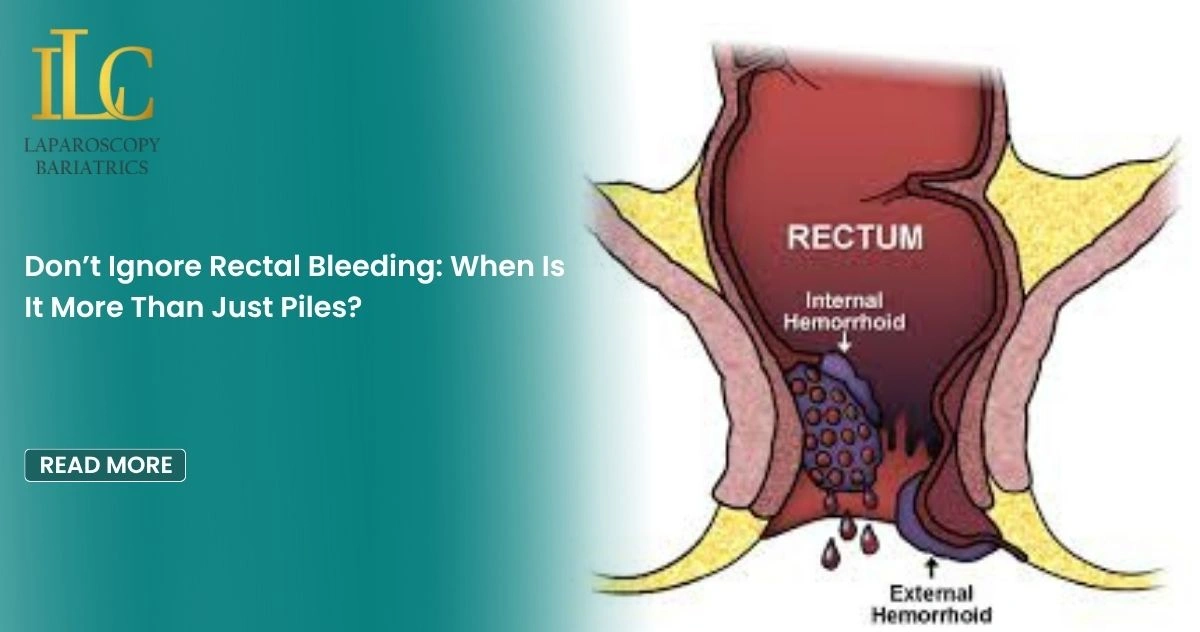 Don’t Ignore Rectal Bleeding When Is It More Than Just Piles