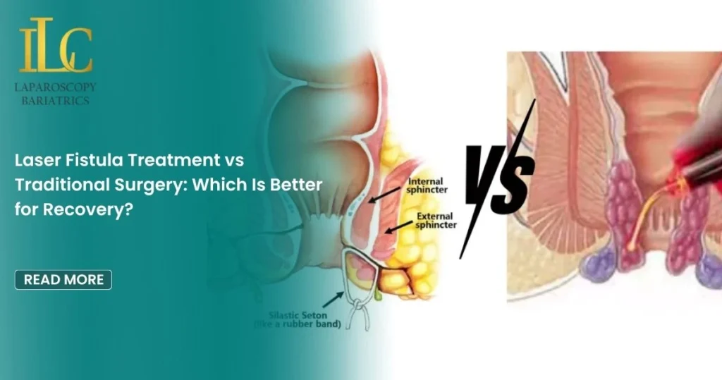 Laser Fistula Treatment vs Traditional Surgery Which Is Better for Recovery