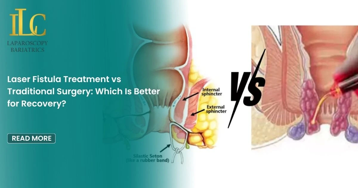 Laser Fistula Treatment vs Traditional Surgery Which Is Better for Recovery
