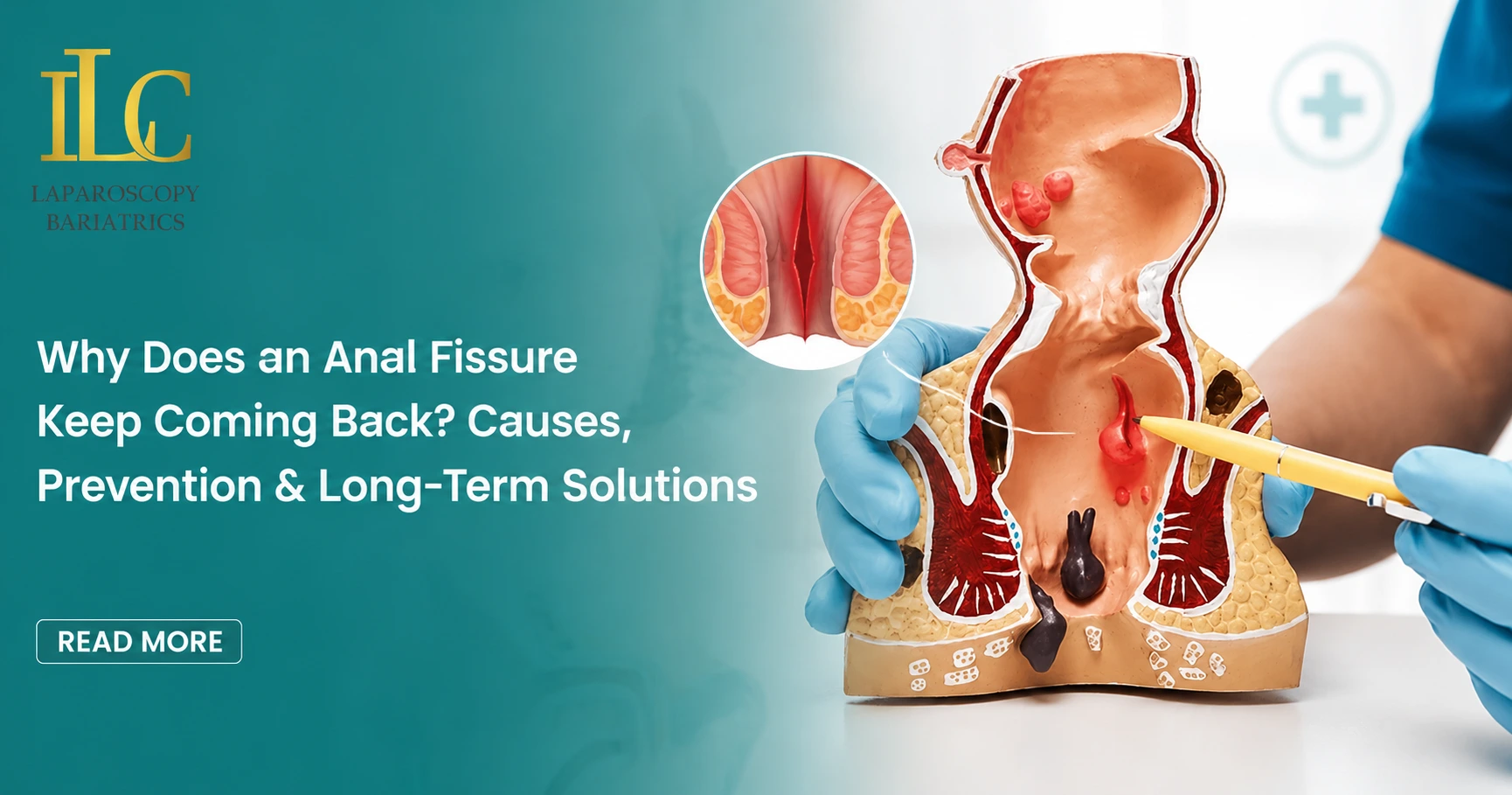 Why Does an Anal Fissure Keep Coming Back Causes, Prevention & Long-Term Solutions (2)