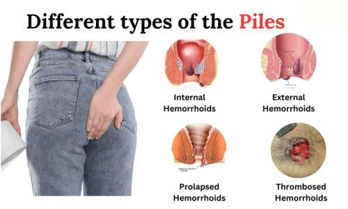 Piles Doctor Indore
